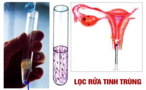 Lọc rửa Tinh Trùng và chọn lọc Tinh Trùng khỏe
