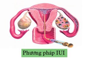 Phương pháp IUI Trọn gói